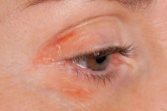 tips-to-deal-with-psoriasis-around-your-eyes-in-hindi